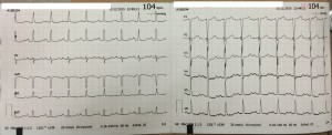 EKG of the week #5 - 2