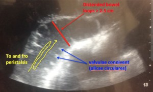 bowel obstruction, ultrasound