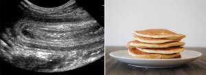 intussusception pancake stack