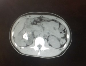 large kidney stone CT