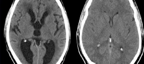 head ct picture
